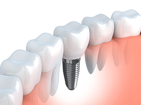 Kruna na implantatu